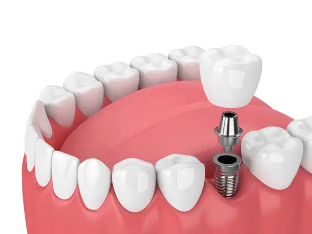 Dental Implants Pleasantville